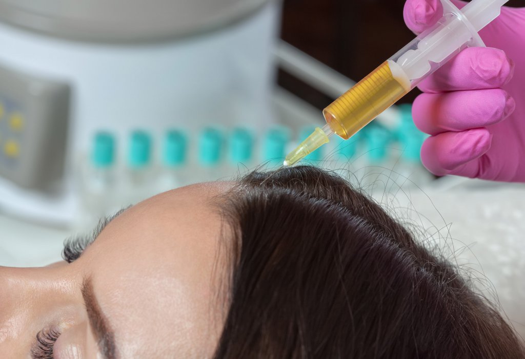 Injection PRP ou Mésothérapie Plaquettaire pour Cheveux Paris 16ème